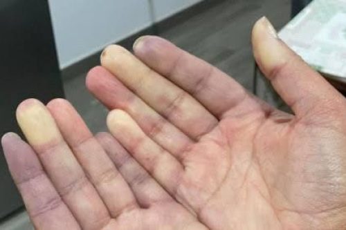 Dedos roxos no frio? Dedos roxos no frio?