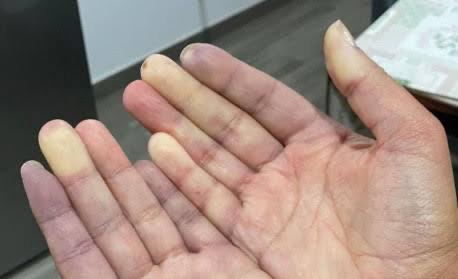 Dedos roxos no frio?